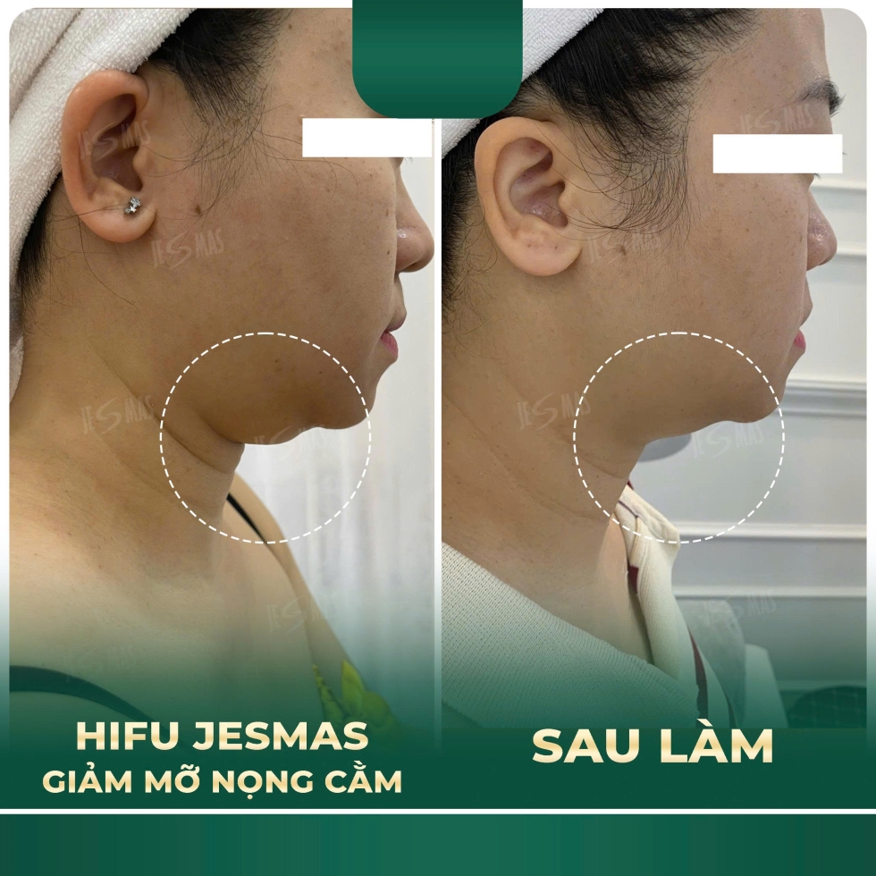 hifugiammonongcamxanhdam2