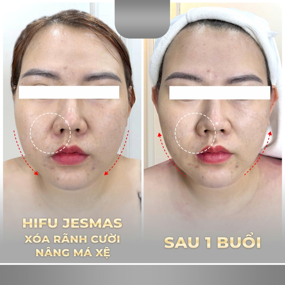 xoaranhcuoinangmaxexam