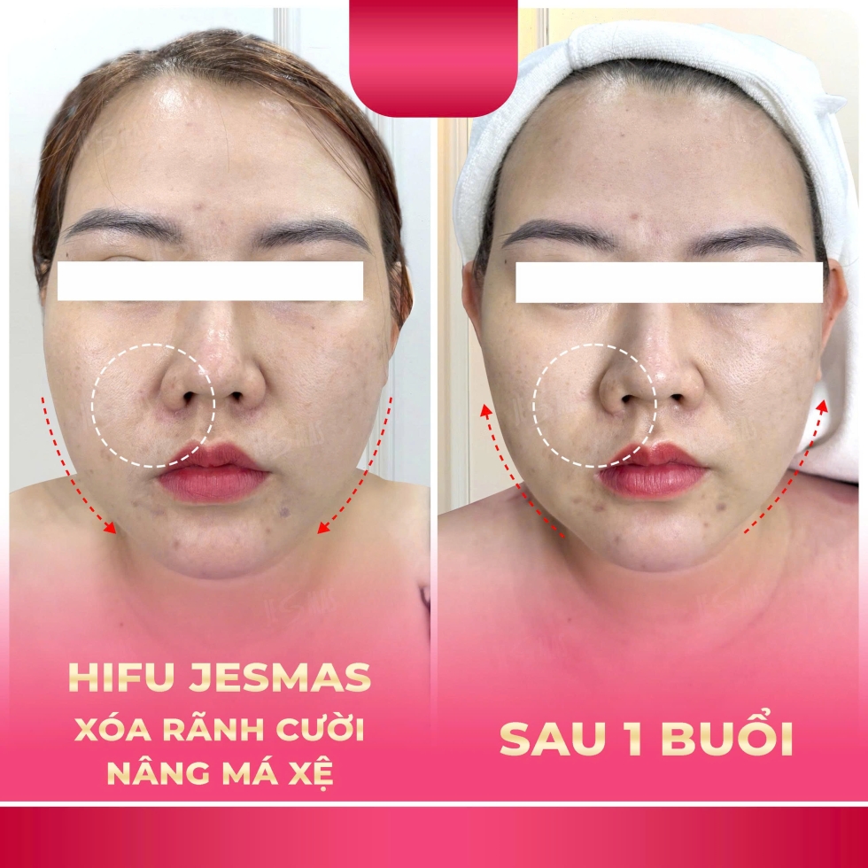 xoaranhcuoinangmaxehong