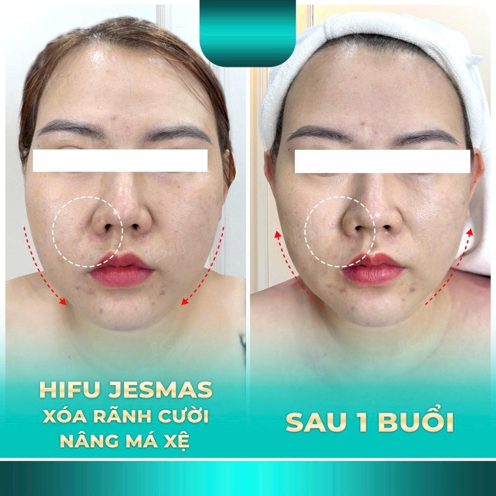 xoaranhcuoinangmaxexanhnhat2