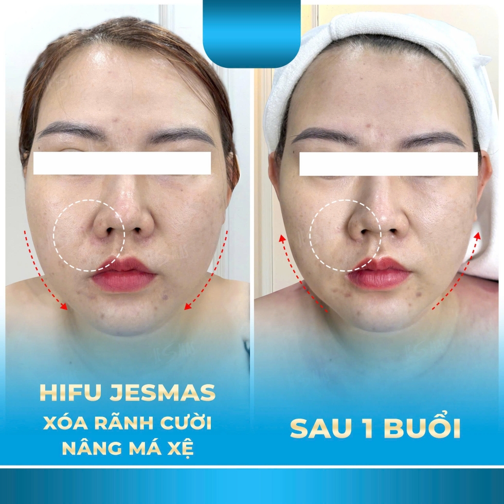 xoaranhcuoinangmaxexanhnhat