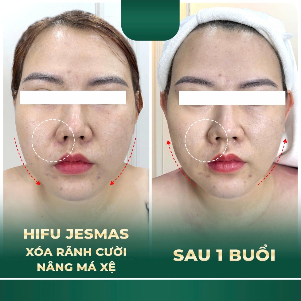 xoaranhcuoinangmaxexanhdam2