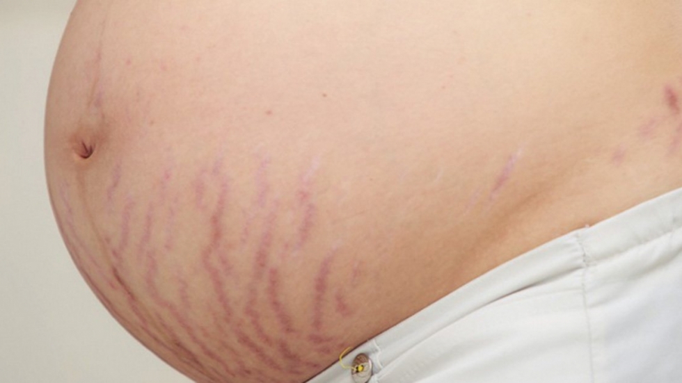Cách trị ngứa rạn da khi mang thai an toàn cho mẹ và bé