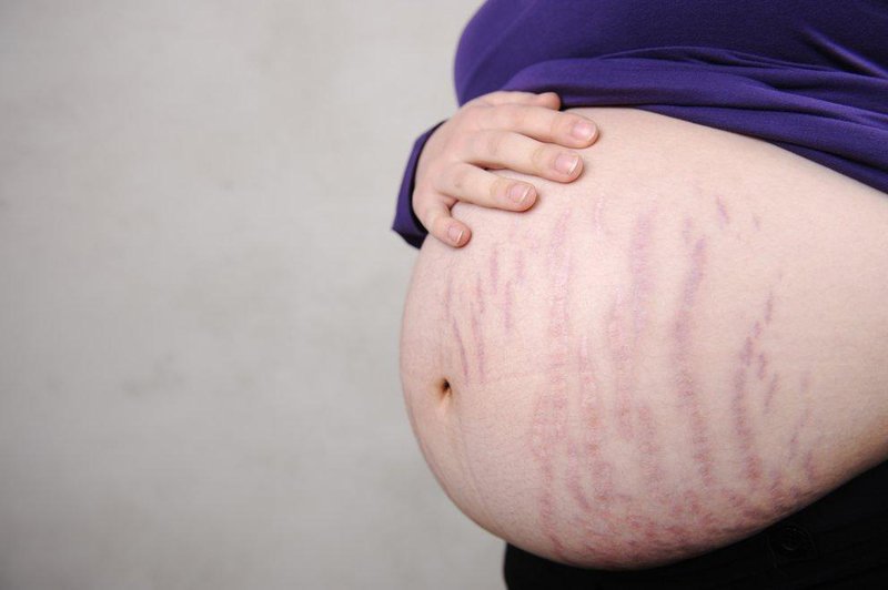 Cách trị ngứa rạn da khi mang thai an toàn cho mẹ và bé